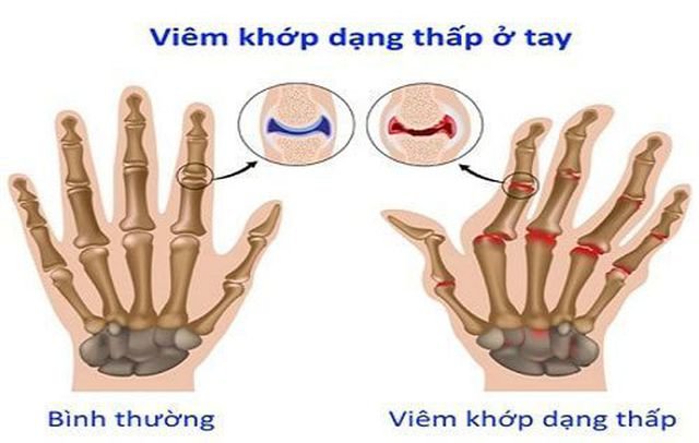 Điều trị và quản lý bệnh viêm khớp dạng thấp