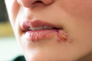 Virus herpes gây bệnh ở môi.